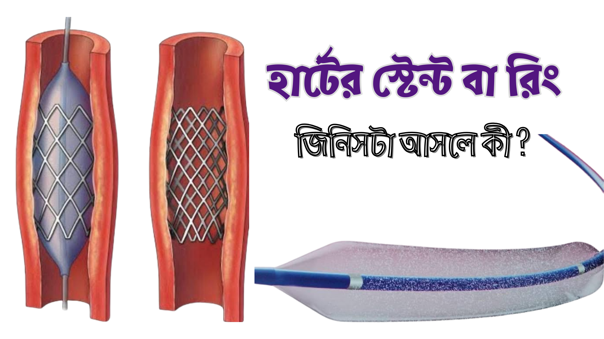 হার্টের স্টেন্ট বা রিং জিনিসটা আসলে কি ?
